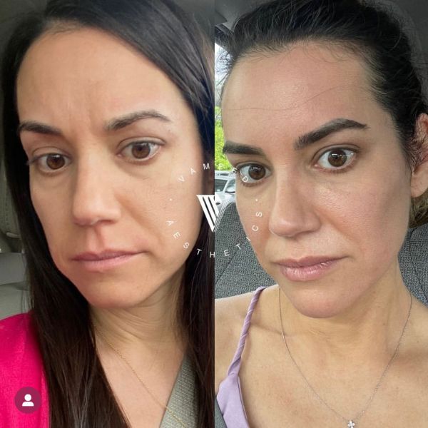 Vamped Aesthetics - Before & After Sculptra Treatment