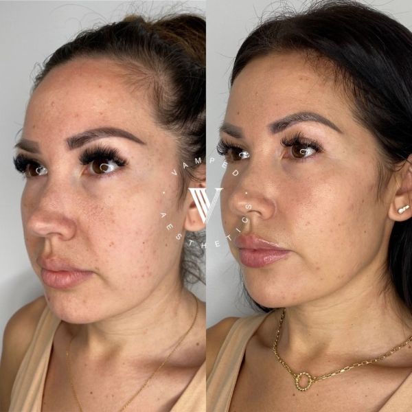 Vamped Aesthetics - Before & After Sculptra Treatment