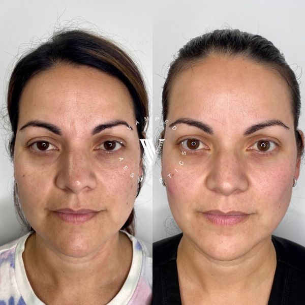 Vamped Aesthetics - Before & After Sculptra Treatment