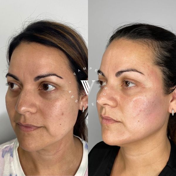 Vamped Aesthetics - Before & After Sculptra Treatment