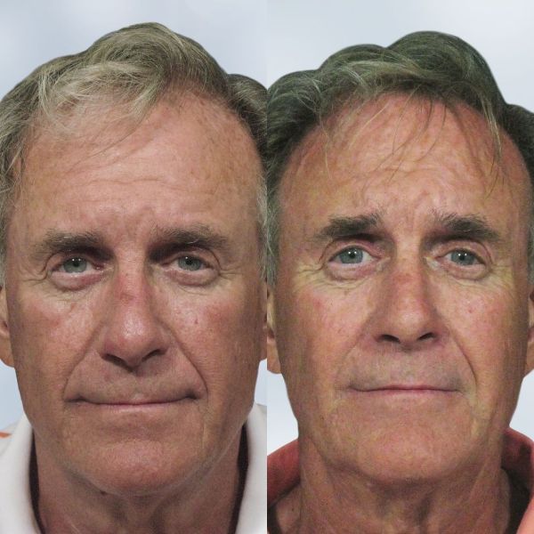 Vamped Aesthetics - Before & After Sculptra Treatment