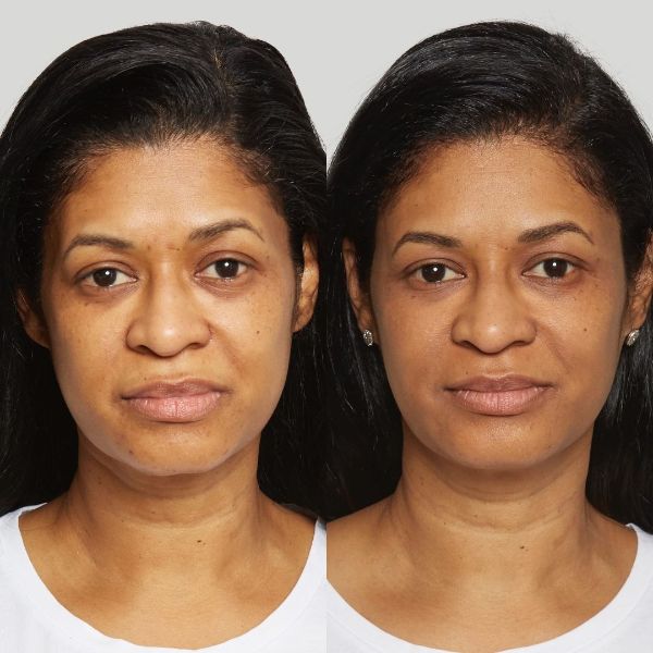 Vamped Aesthetics - Before & After Sculptra Treatment