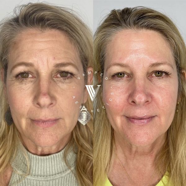 Vamped Aesthetics - Before & After Skincare