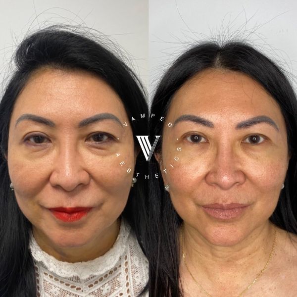 Vamped Aesthetics - Before & After Skincare