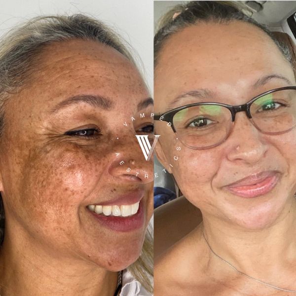 Vamped Aesthetics - Before & After Skincare