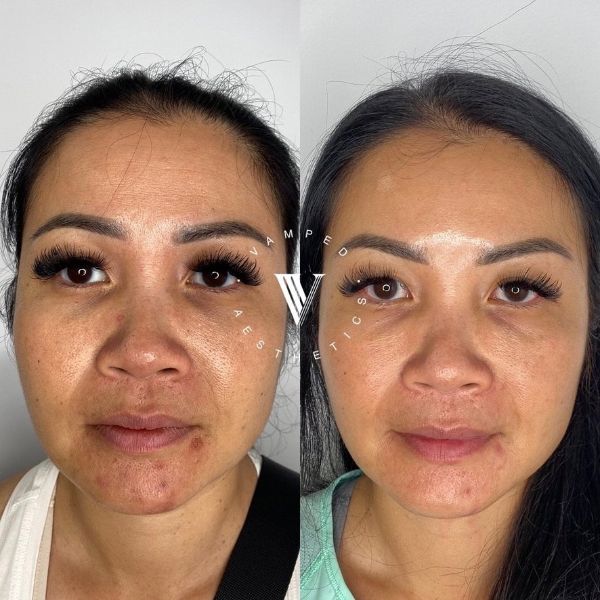 Vamped Aesthetics - Before & After Skincare