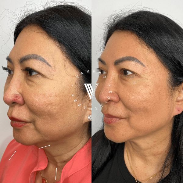 Vamped Aesthetics - Before & After Skincare