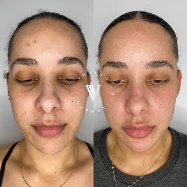 Vamped Aesthetics - Before & After Skincare